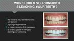 Prezentációk 'Professional Teeth Bleaching', 2.                