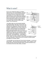 Összefoglalók, jegyzetek 'Acne', 4.                